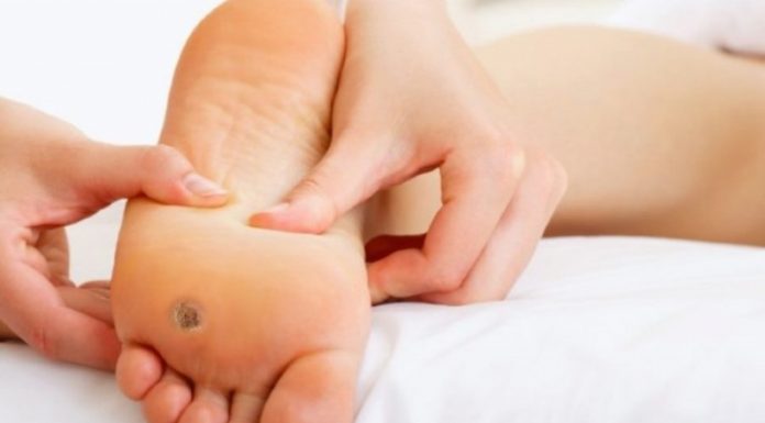 Заговоры от подошвенных бородавок