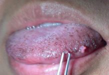 Причины образования папиллом на языке