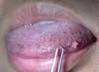 Причины образования папиллом на языке