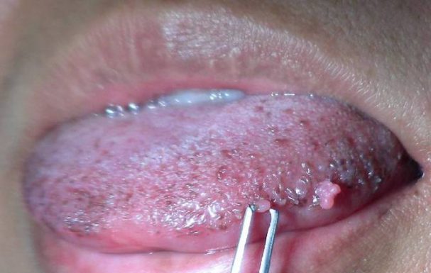 Причины образования папиллом на языке