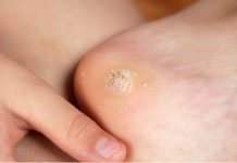 Чистотел от шипиц