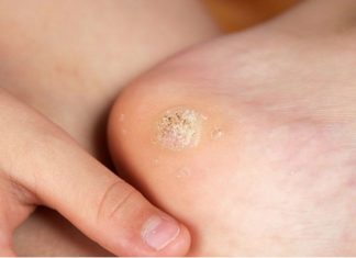 Чистотел от шипиц