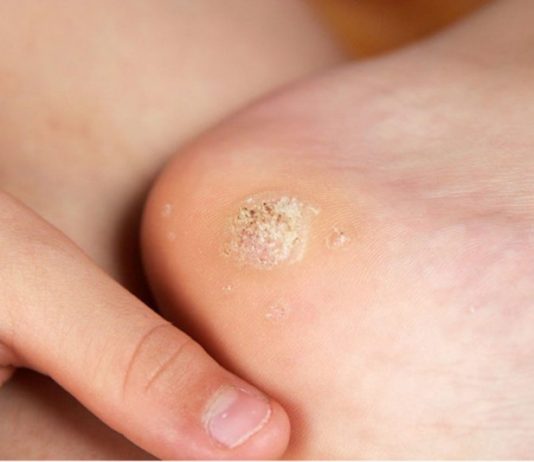 Чистотел от шипиц