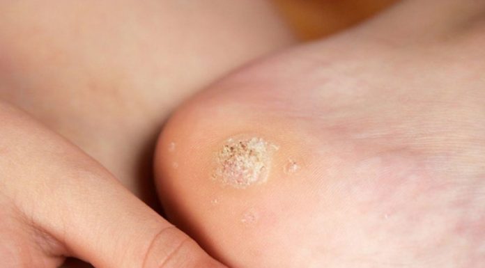 Чистотел от шипиц