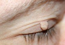 Причины образования папиллом на веке