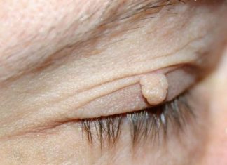 Причины образования папиллом на веке