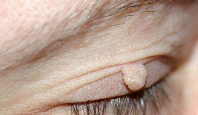 Причины образования папиллом на веке