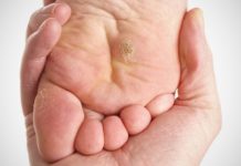 Лечение шипиц на ступнях