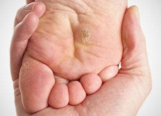 Лечение шипиц на ступнях