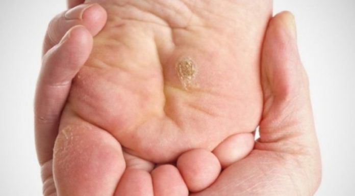 Лечение шипиц на ступнях