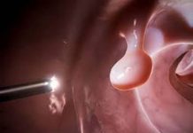 Папиллома – что это?