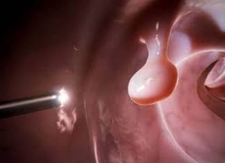 Папиллома – что это?