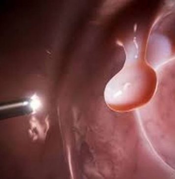 Папиллома – что это?