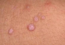 Папилломы на половых органах