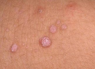 Папилломы на половых органах