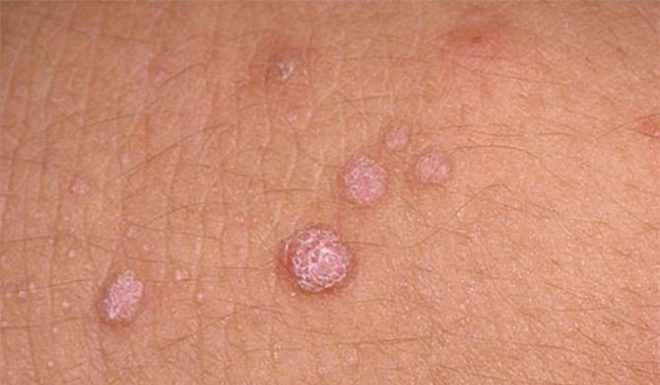 Папилломы на половых органах